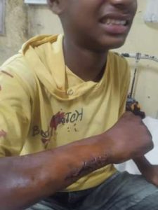 Karteek with infected wound